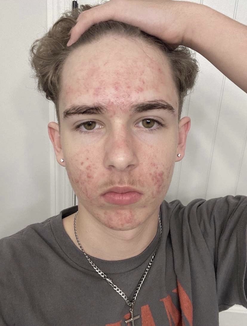 Customer photo before, showing red spots across the forehead and cheeks